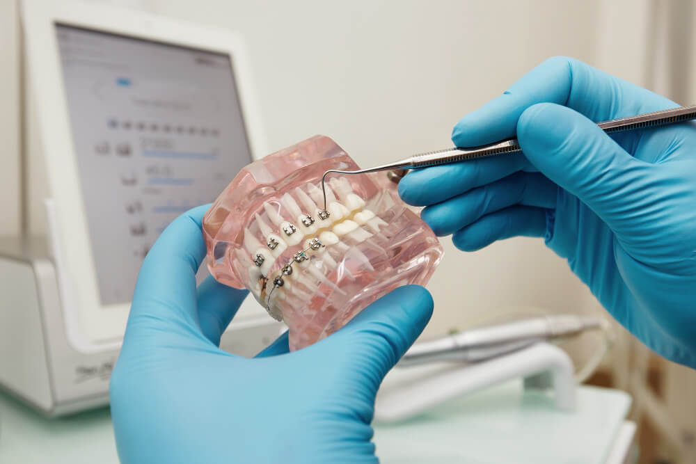Tipos de ortodoncias